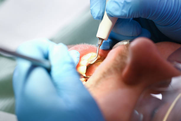 Best Emergency Dental Extractions in Moline, IL